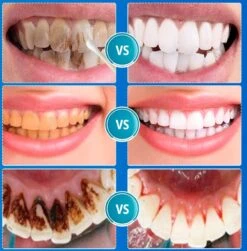Blanchiment Des Dents B-care - Dents Plus Blanches - Bandes De Blanchiment Des Dents - Résultat Professionnel - Détartrant - Sans Peroxyde - Ensemble De Blanchiment Des Dents - Blanchiment Des Dents -Dentaires Appareils Magasin 1181x1200 1