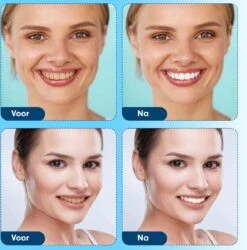 Bandes De Blanchiment Avancées 28 Pièces - Sans Peroxyde (0%) - 100% Sûr - Dents Plus Blanches - Bandes De Blanchiment Des Dents - Blanchisseurs De Blanchisseurs De Dents -Dentaires Appareils Magasin 1185x1200