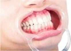 10 Pièces Dilatateurs De Bouche Taille L- Pour Le Blanchiment Des Dents - Travail Dentaire - Diffuseur De Bouche - Ouvre-joue -Dentaires Appareils Magasin 1200x861